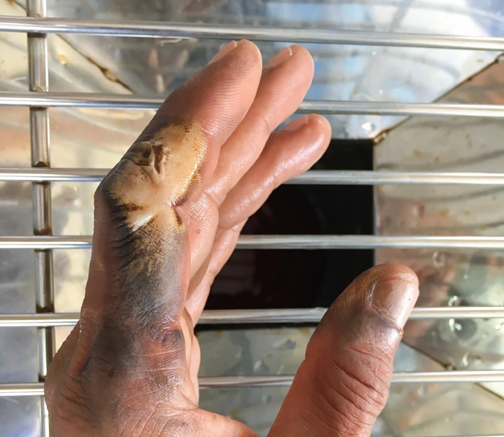 Can I Sue for Burn Injury in Indiana? Stracci Law Group